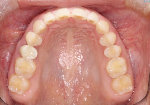【空隙歯列】ワイヤー矯正で短期間に治療を終えたいの治療後