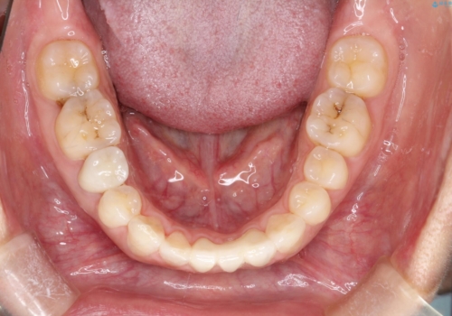 【空隙歯列】ワイヤー矯正で短期間に治療を終えたいの治療後