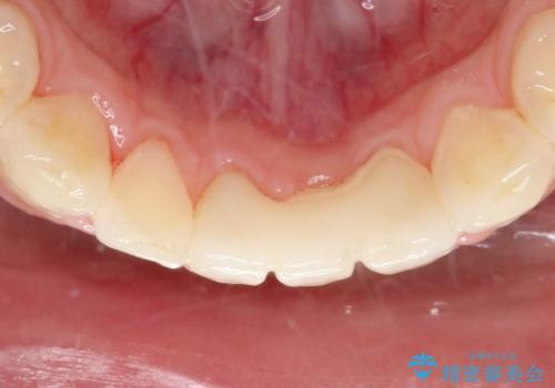 【前歯ブリッジ】下顎前歯の先天性欠如の補綴治療の治療後
