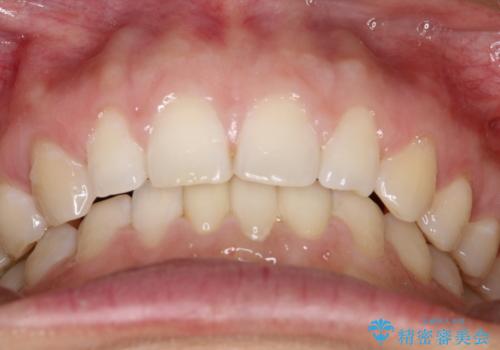 【空隙歯列】ワイヤー矯正で短期間に治療を終えたいの治療後