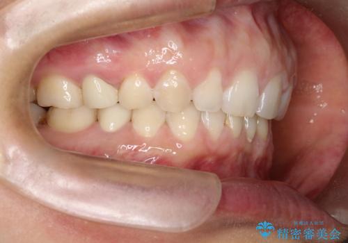 【空隙歯列】ワイヤー矯正で短期間に治療を終えたいの治療後