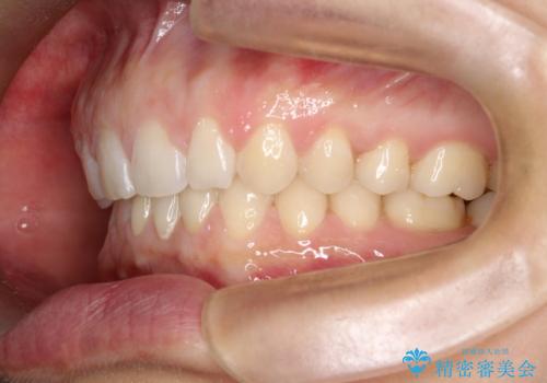 【空隙歯列】ワイヤー矯正で短期間に治療を終えたいの治療後