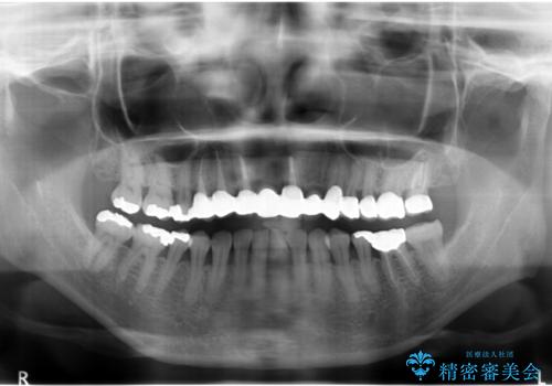 前歯のブリッジの下が虫歯 ブリッジのやりかえの治療後