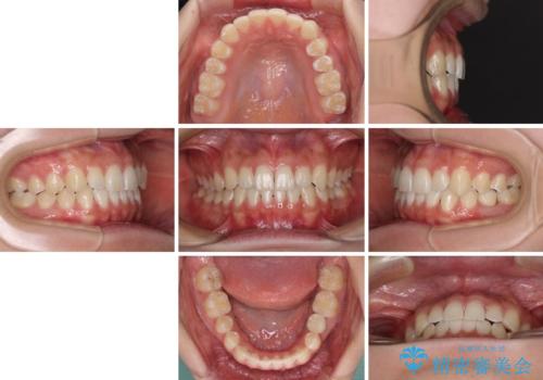 乳歯を抜いてインプラントに 咬み合わせ改善のインビザライン矯正の治療後