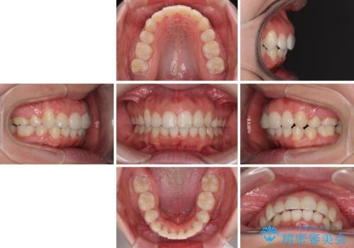 著しい叢生と顎骨のズレ ワイヤー装置による抜歯矯正の治療後
