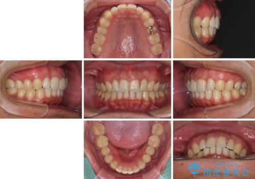 上顎の出っ歯とすきっ歯 補助装置を用いたインビザライン矯正の治療後