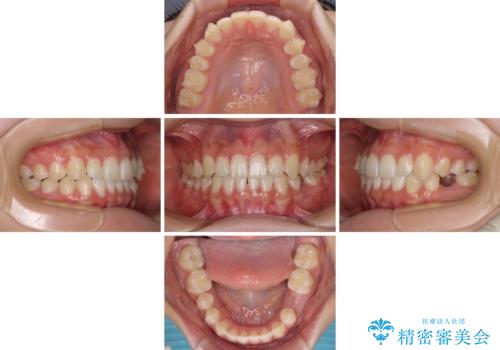 乳歯を抜いてインプラントに 咬み合わせ改善のインビザライン矯正の治療中