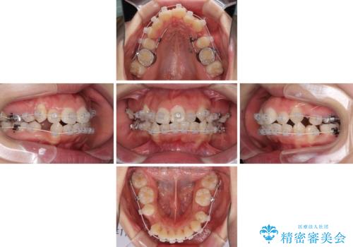 著しい叢生と顎骨のズレ ワイヤー装置による抜歯矯正の治療中
