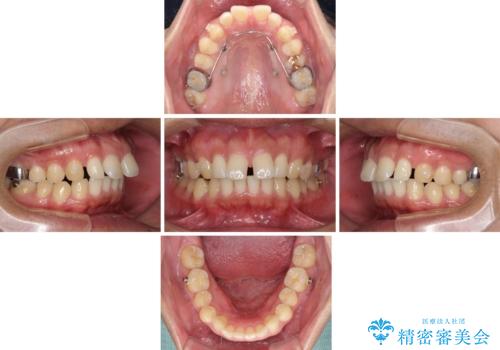 上顎の出っ歯とすきっ歯 補助装置を用いたインビザライン矯正の治療中