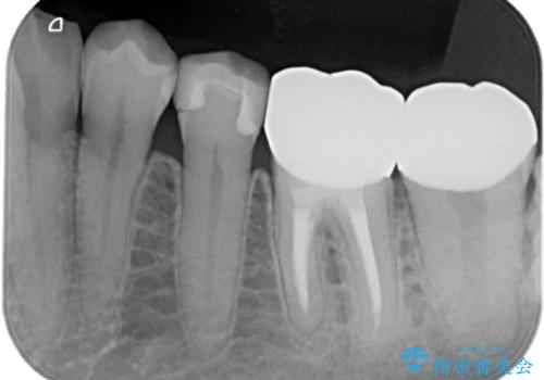 金属を白くしたい、セラミックへの治療後