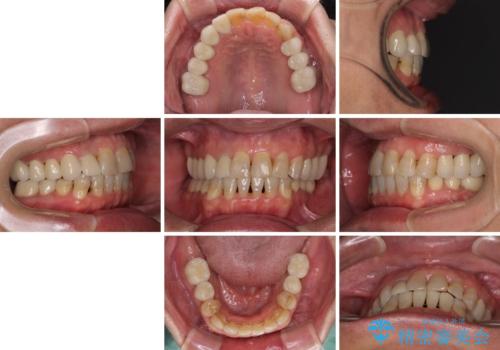 歯列不正と歯周病 総合歯科治療による全顎治療の治療後