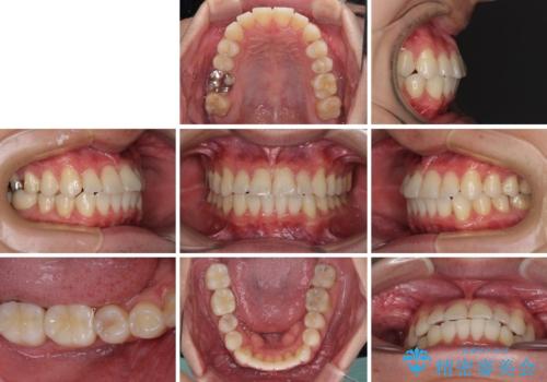 冷たいものがしみて奥歯が痛い 気になる歯並びも治したの治療後