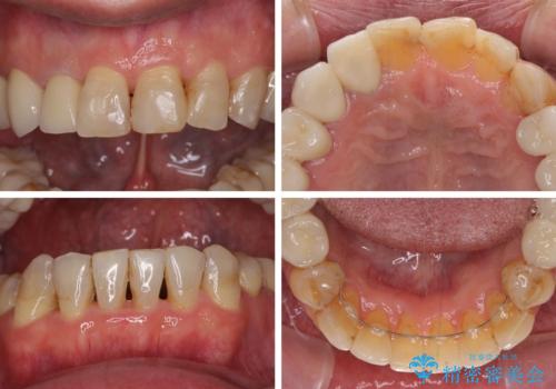 歯列不正と歯周病 総合歯科治療による全顎治療の治療後