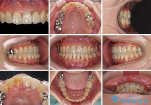 反対咬合で痛む前歯を改善 インビザラインによる矯正治療の治療後