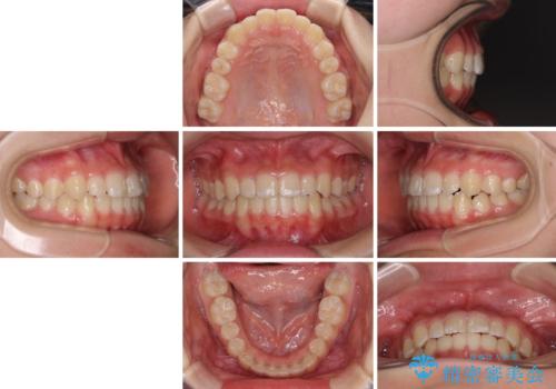 遠方から新幹線で通院 急速拡大装置とインビザラインによる矯正治療の治療後