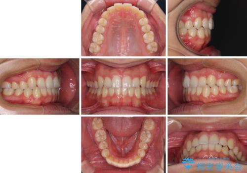 狭い歯列と前歯のデコボコ インビザラインによる矯正治療の治療後