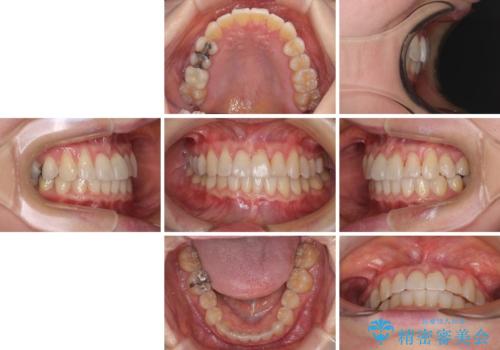 前歯のクロスバイト　インビザライン矯正で改善の治療後