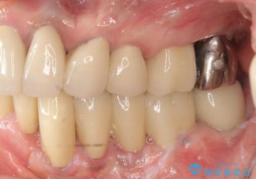 少ない残存歯質　抜歯ギリギリの歯を残すの症例 治療後