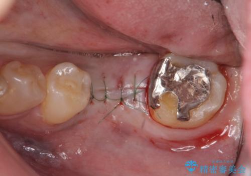 強い噛み合わせによる歯牙破折後のインプラント治療の治療中