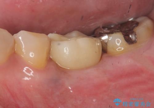 強い噛み合わせによる歯牙破折後のインプラント治療の症例 治療後