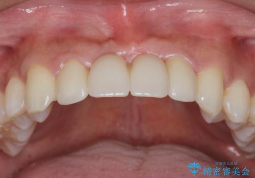 [ 審美歯科 ]前歯のブリッジをやりかえたいの症例 治療後