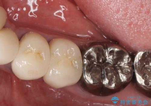 少ない残存歯質　抜歯ギリギリの歯を残すの治療前