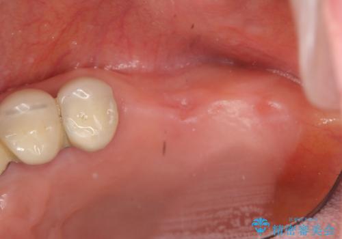 遊離端ブリッジ インプラント補綴への設計変更の治療前