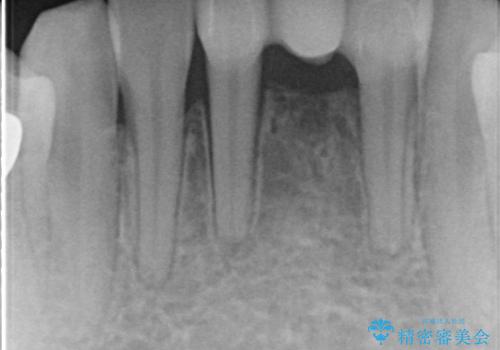 【前歯ブリッジ】下顎前歯の先天性欠如の補綴治療の治療後