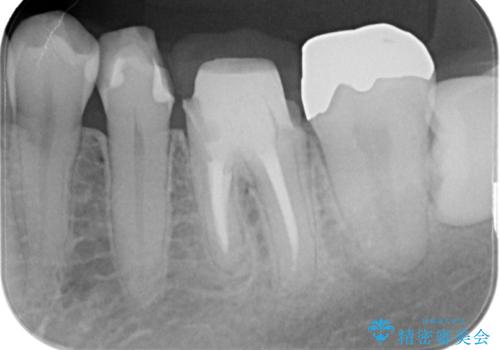 金属を白くしたい、セラミックへの治療中