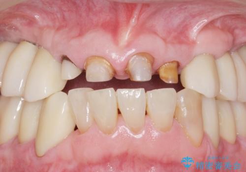 被せ物がとれたまま放置していた セラミックで綺麗に 50代男性の治療中