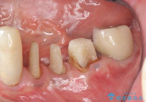 少ない残存歯質　抜歯ギリギリの歯を残すの治療中