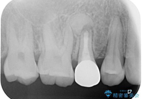 【中心結節破折】MTAセメントを用いたアペキシフィケーションの症例 治療後
