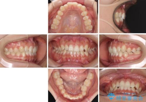 乳歯を抜いてインプラントに 咬み合わせ改善のインビザライン矯正の治療前