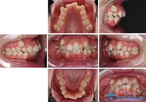 著しい叢生と顎骨のズレ ワイヤー装置による抜歯矯正の治療前