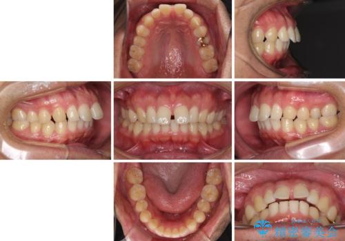 上顎の出っ歯とすきっ歯 補助装置を用いたインビザライン矯正の治療前