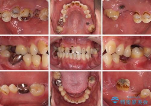 とにかく作り物のような真っ白な歯にしたい フルジルコニアクラウンによる補綴治療の治療前
