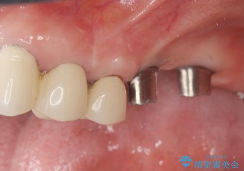 遊離端ブリッジ インプラント補綴への設計変更の治療中