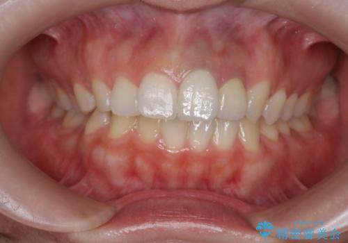 [セラミック治療] 前歯の見た目をきれいにしたいの治療後