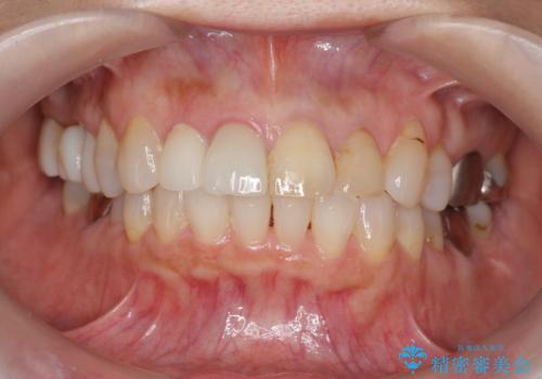 [ 前歯ジルコニアブリッジ ]  前歯の突き上げによる歯牙破折の治療前