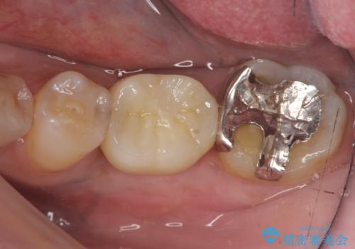 強い噛み合わせによる歯牙破折後のインプラント治療の治療後