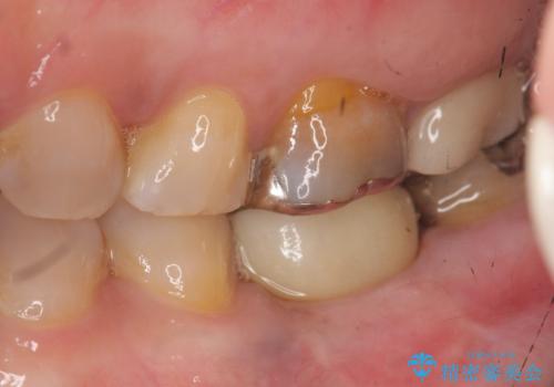 強い噛み合わせによる歯牙破折後のインプラント治療の治療後