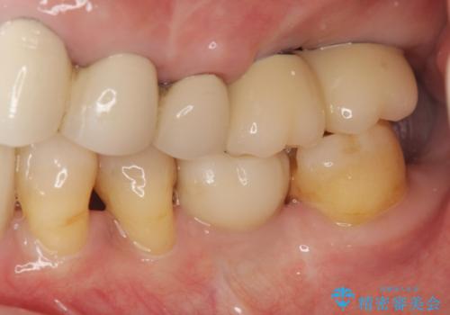 遊離端ブリッジ インプラント補綴への設計変更の治療後