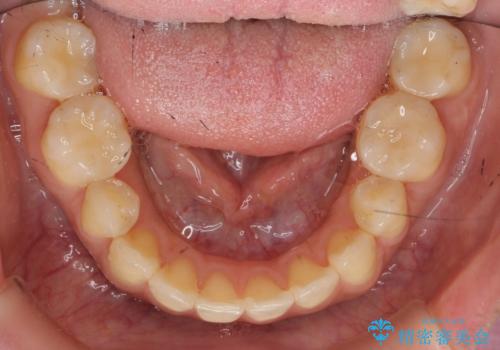 笑った時の印象を変えるメタルフリー治療