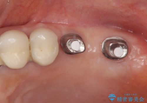 遊離端ブリッジ インプラント補綴への設計変更の治療中