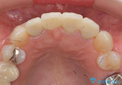 [ 前歯ジルコニアブリッジ ]  前歯の突き上げによる歯牙破折の治療後