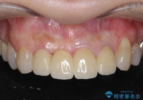 [ 前歯ジルコニアブリッジ ]  前歯の突き上げによる歯牙破折の症例 治療後