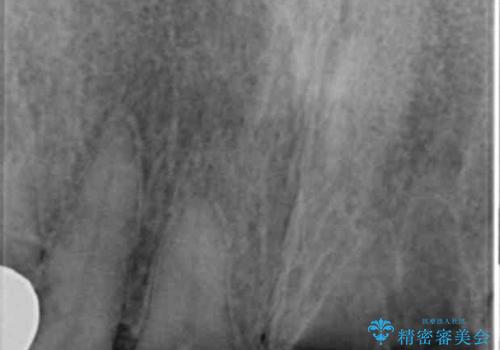 交通事故で前歯が折れた マグネットデンチャー 50代男性の治療前