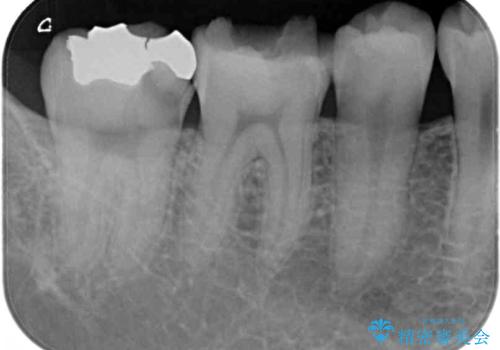 冷たいものがしみて奥歯が痛い 気になる歯並びも治したの治療前