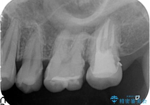 憧れの芸能人のような白い歯に 30代男性の治療前