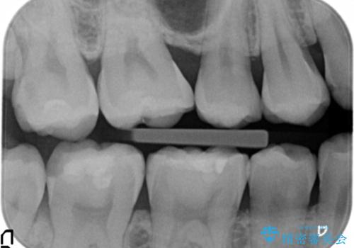 奥歯にフロスを通すと臭い 30代女性の治療前